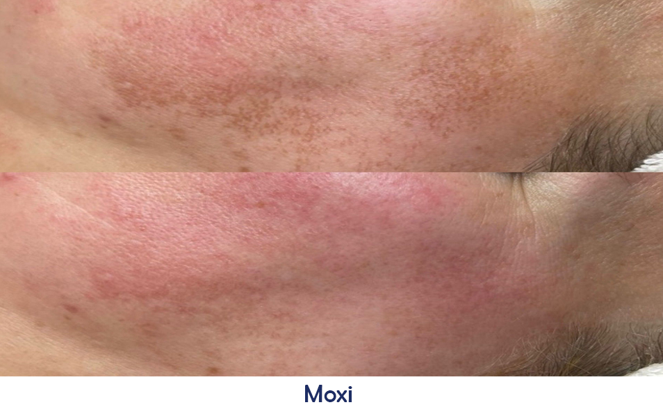 A before and after photo of a person's face with red spots.