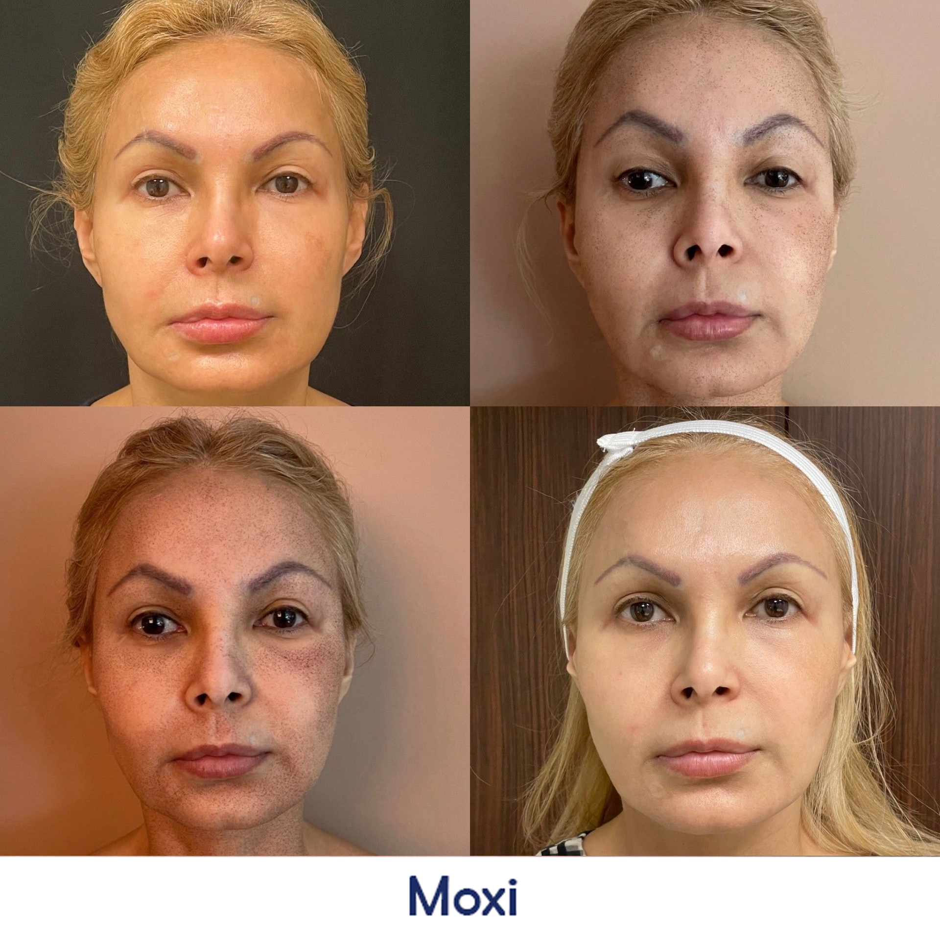 A before and after photo of a woman's face.