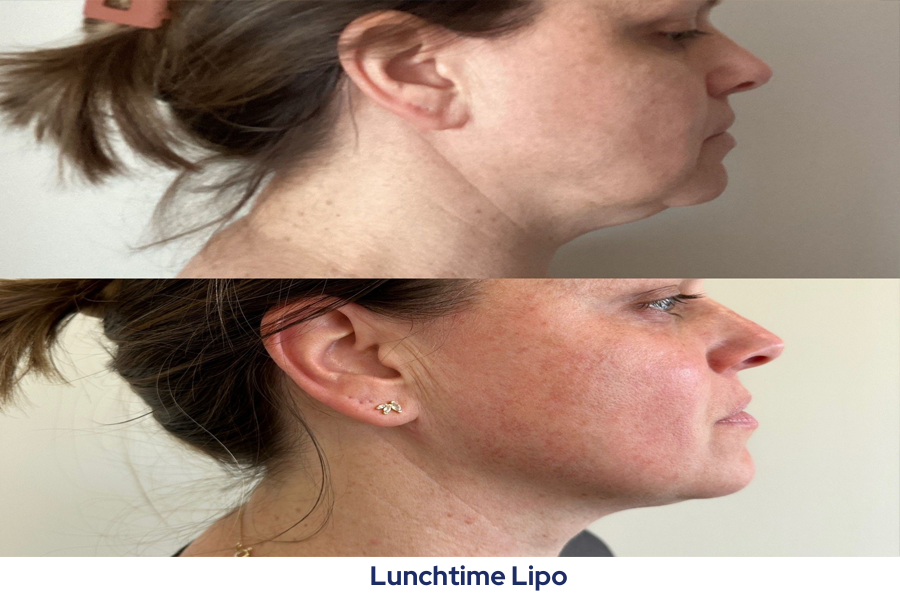 A before and after photo of a woman's neck and face.