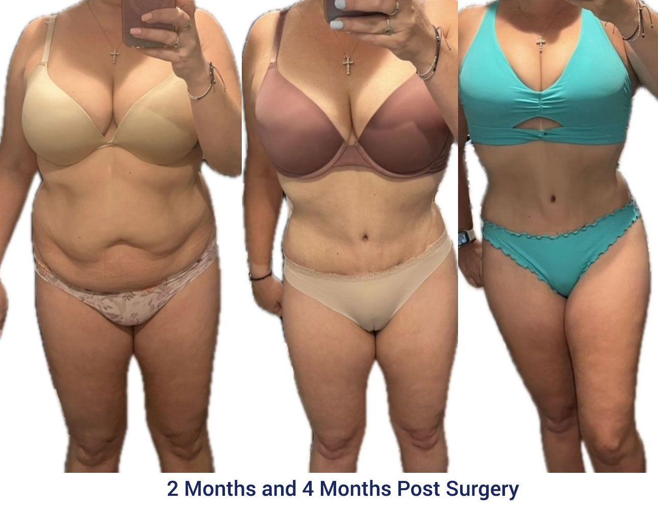 Abdominoplasty 2 months and 4 months post surgery
