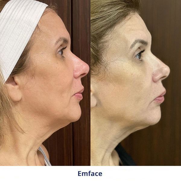 Emface Before and After Treatment