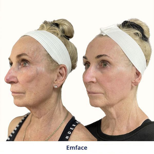 Emface Before and After Treatment