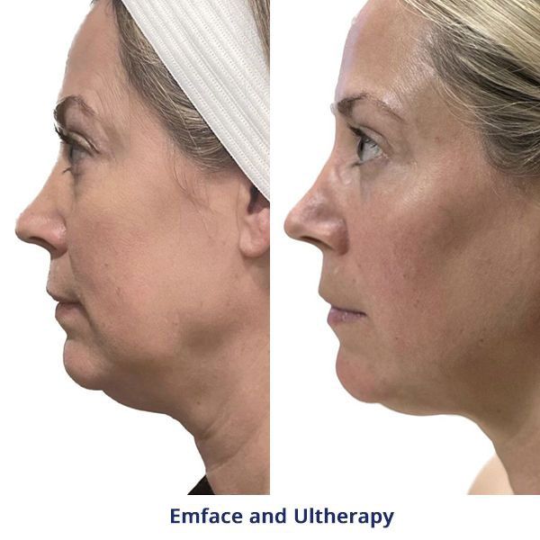 Emface and Ultherapy Before and After