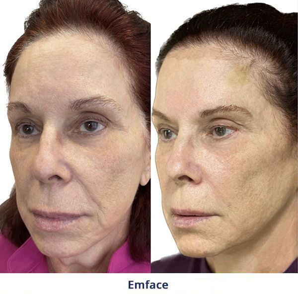 Emface Before and After Treatment
