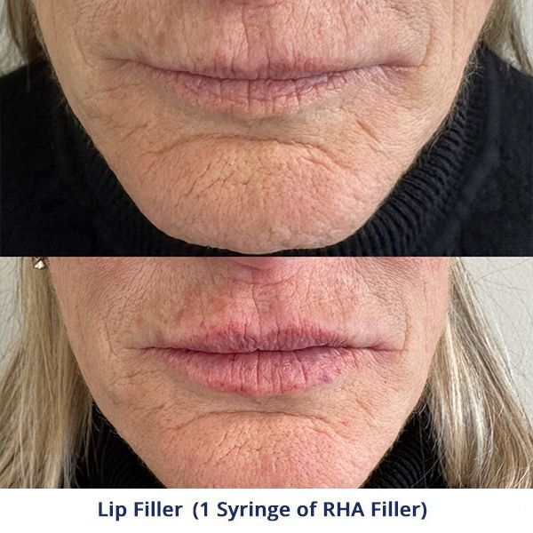 Lip Filler (1 Syringe of RHA Filler)