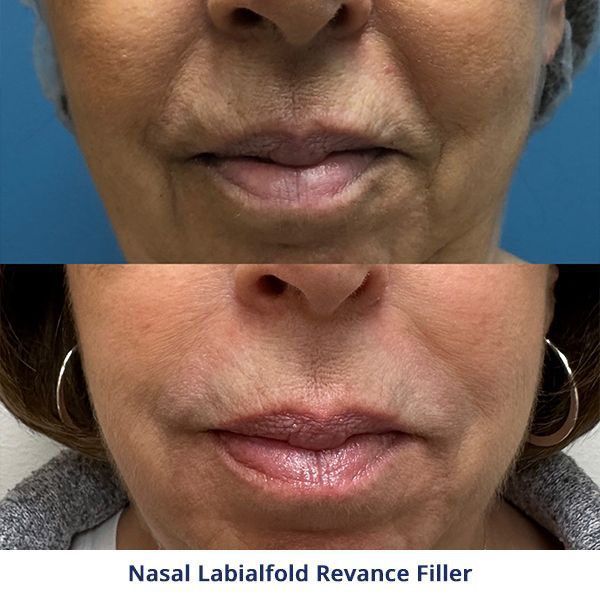 Nasal Labialfold Revance Filler
