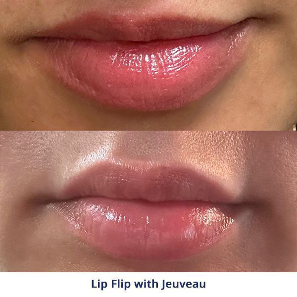 Lip Flip with Jeuveau treatment