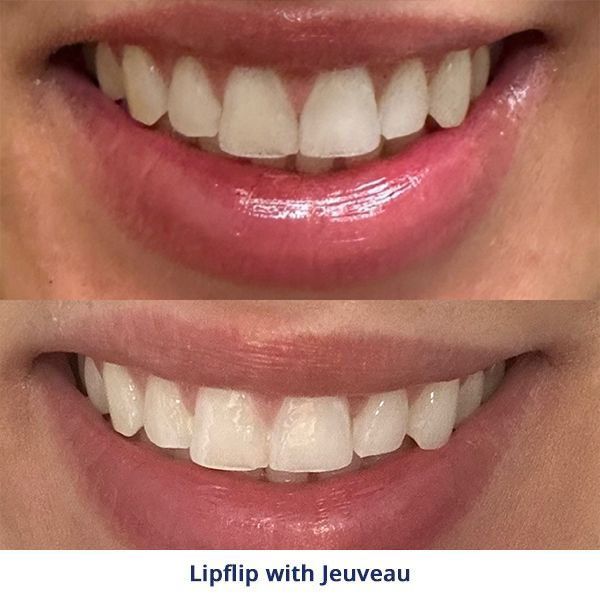 Lipflip with Jeuveau