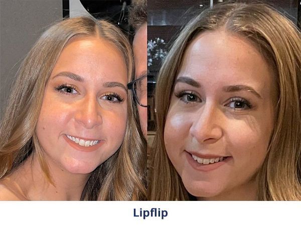 Lipflip