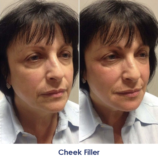 A woman's face before and after a cheek filler treatment.