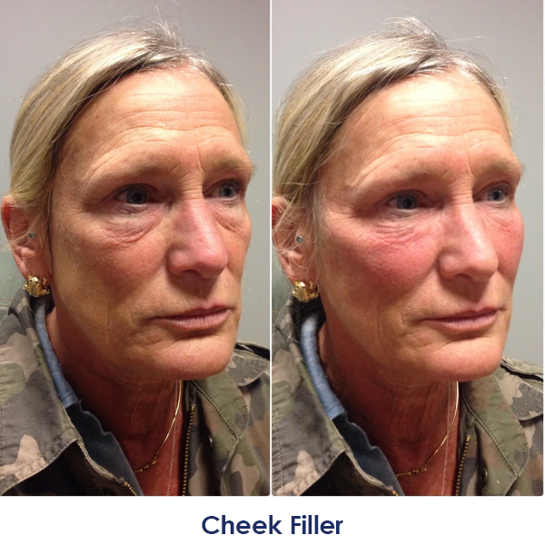 A woman's face before and after a cheek filler treatment.