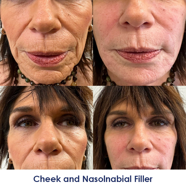 A before and after photo of a woman's cheek and nasolabial filler.