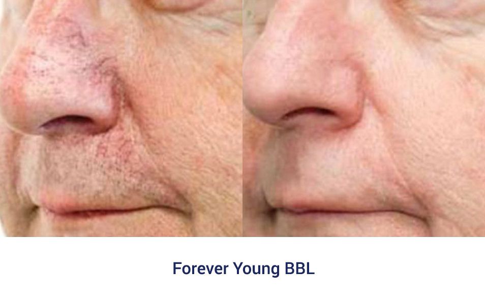 forever young bbl treatment