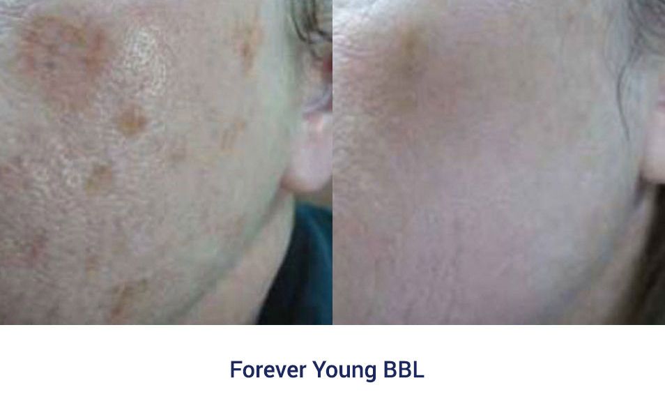 forever young bbl before and after