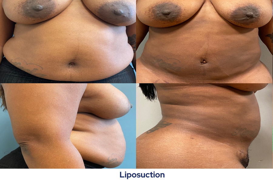 Liposuction