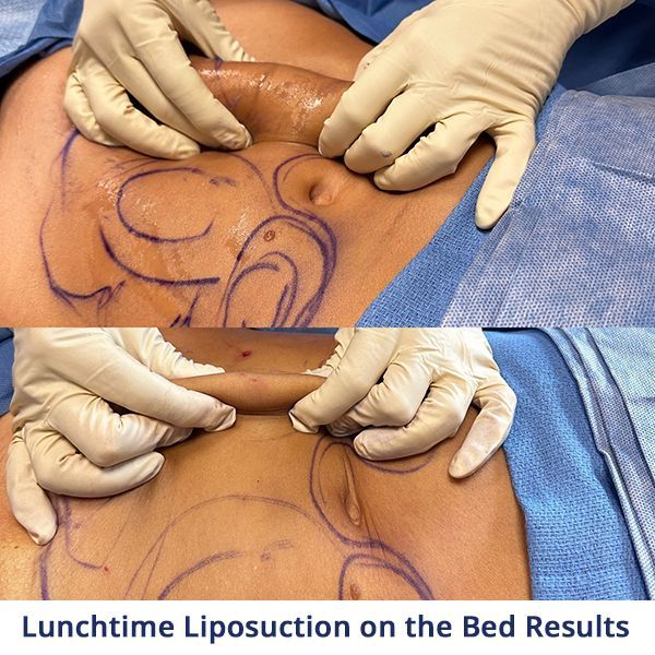 Lunchtime Liposuction on Bed Results