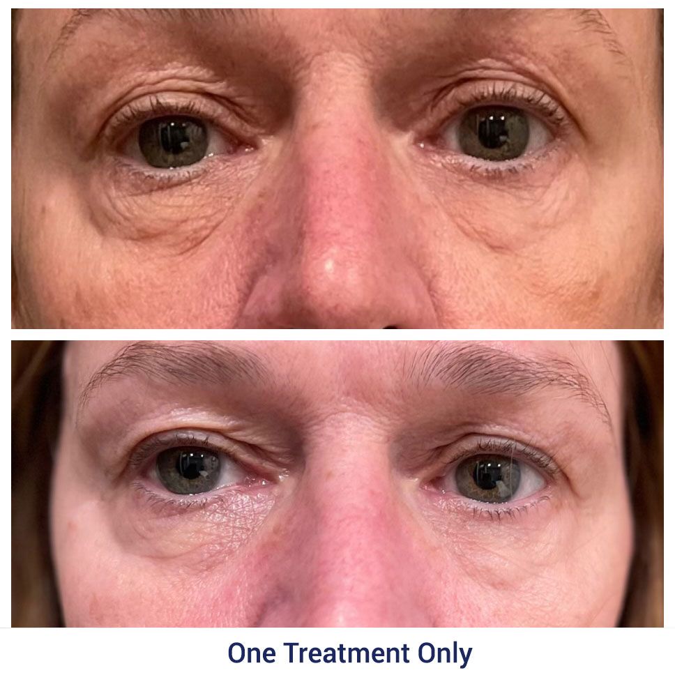 before and after one treatment of 
Morpheus8