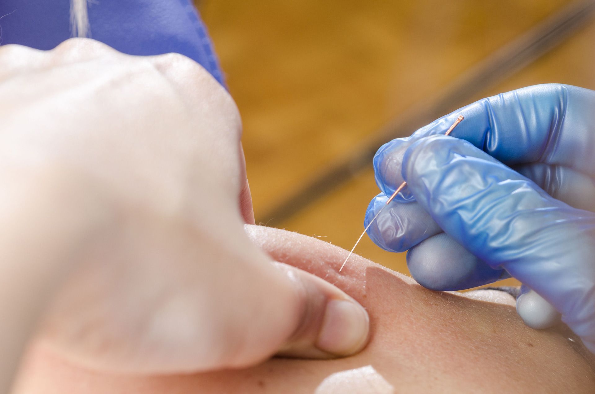 A person is getting an acupuncture treatment on their arm.
