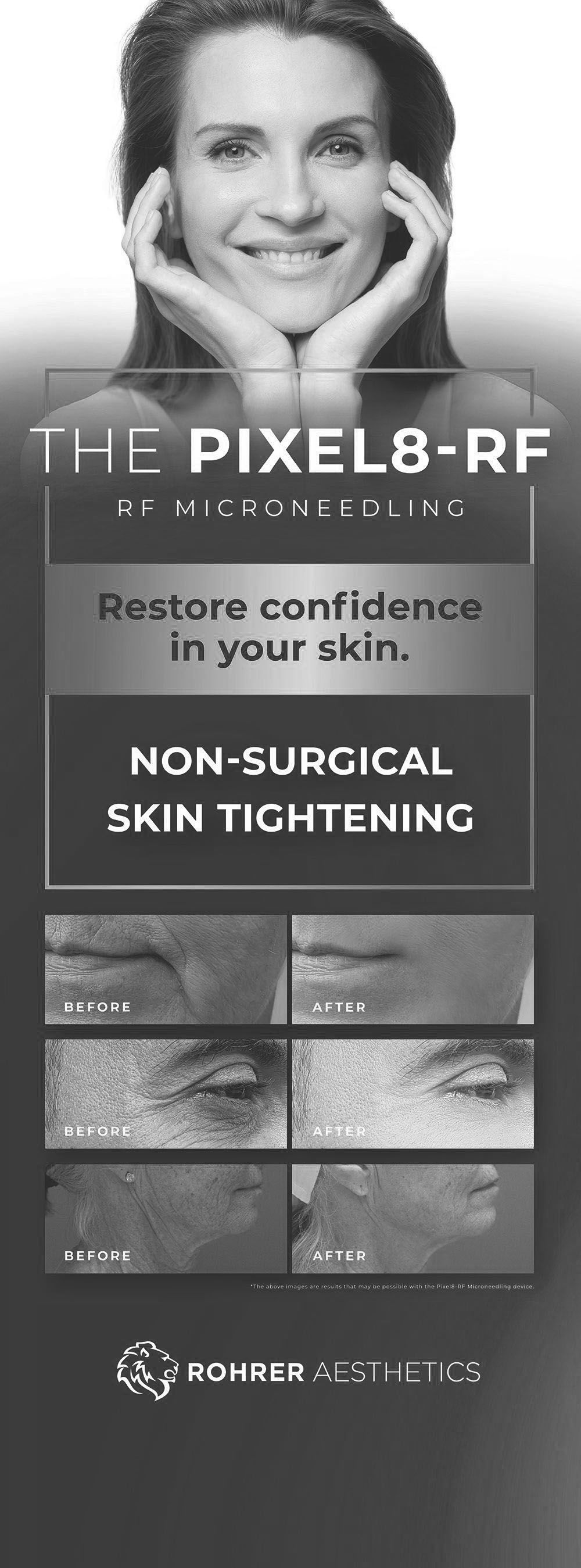 Pixel8-RF – Radiofrequency with microneedling banner