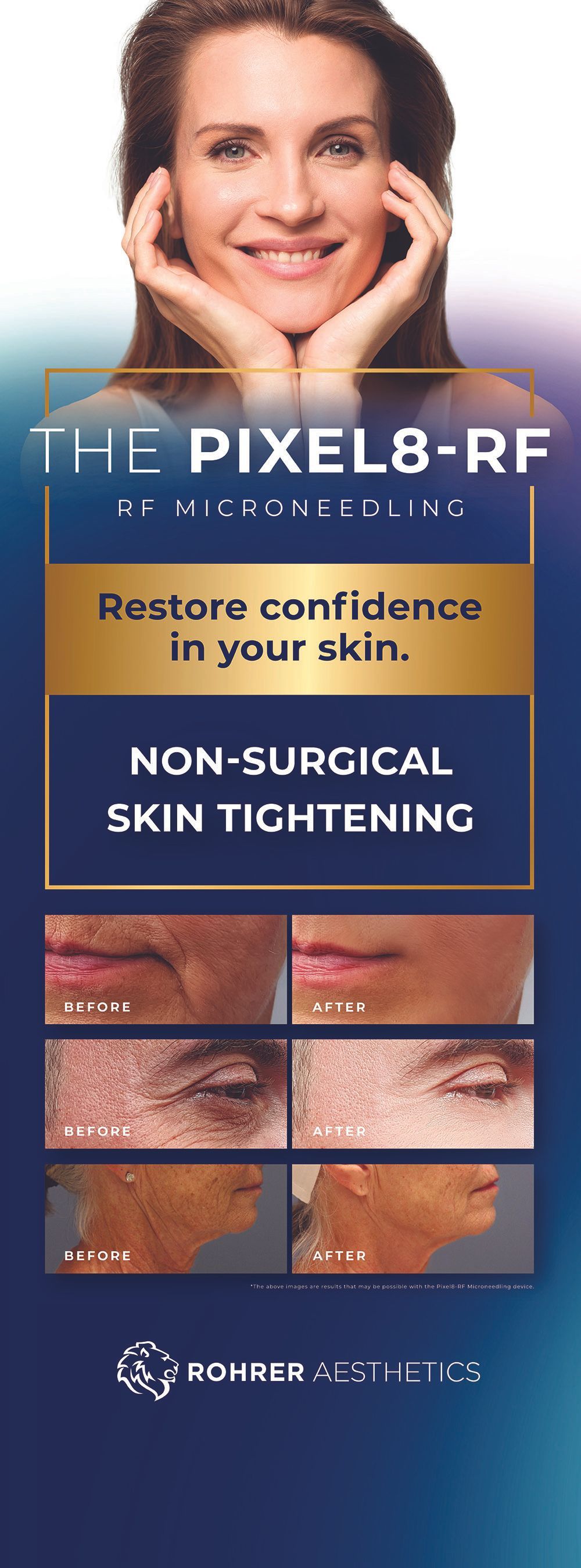 Pixel8-RF – Radiofrequency with microneedling banner