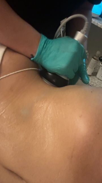 Brazilian Butt lift service