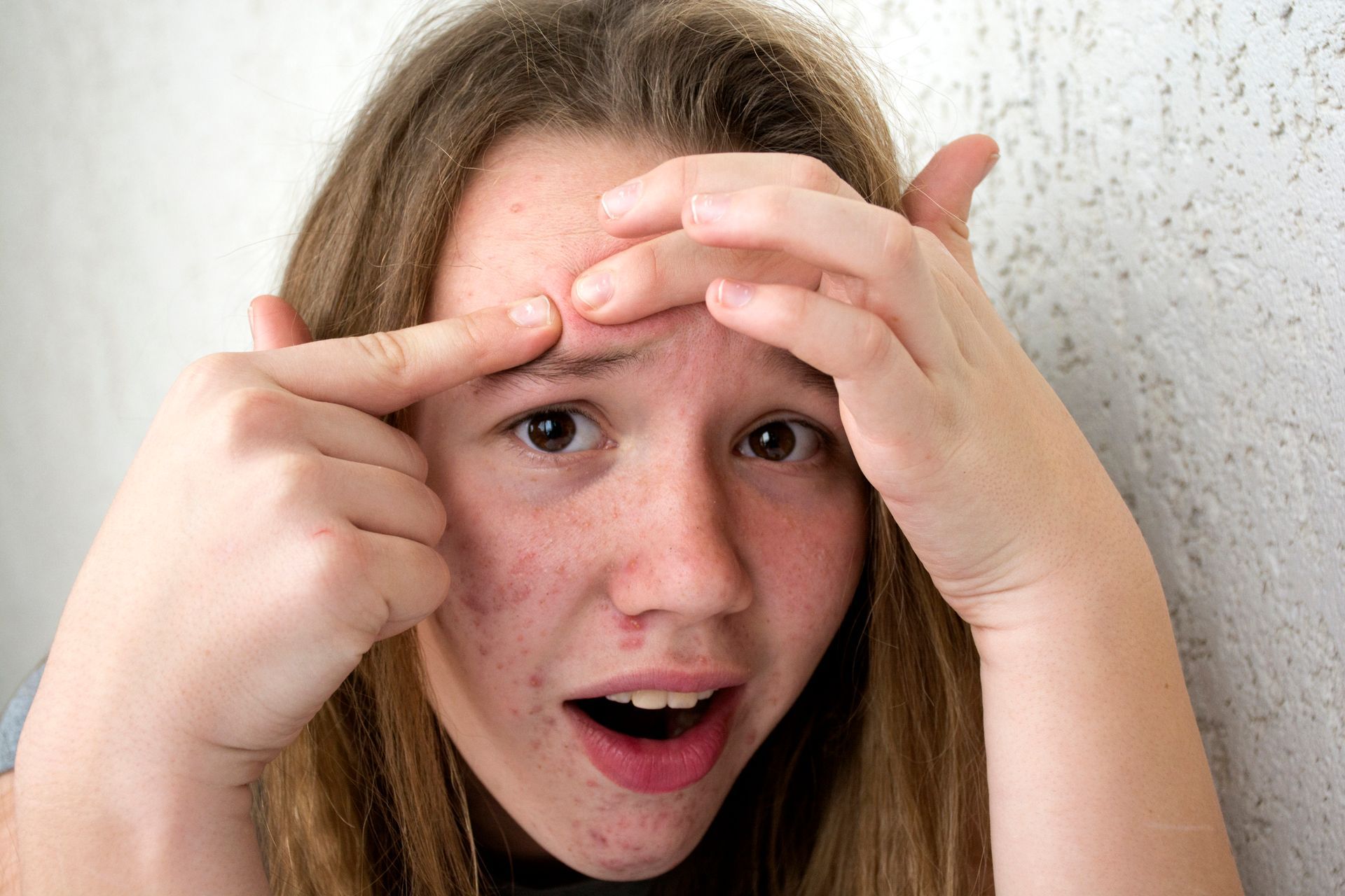 A young girl with acne is squeezing a pimple on her forehead.