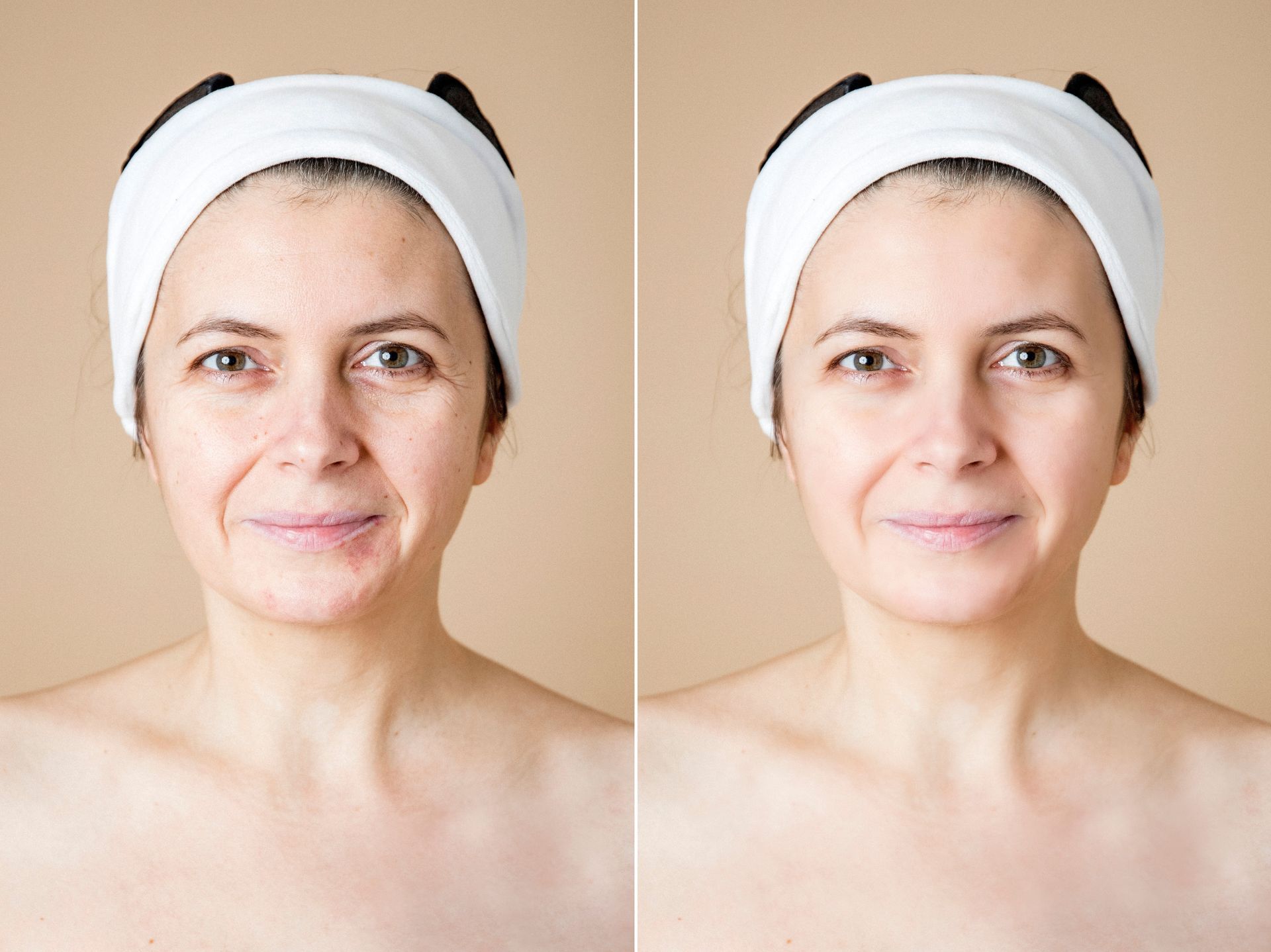 Before and after comparison of a person's face showing reduced wrinkles and smoother skin texture.