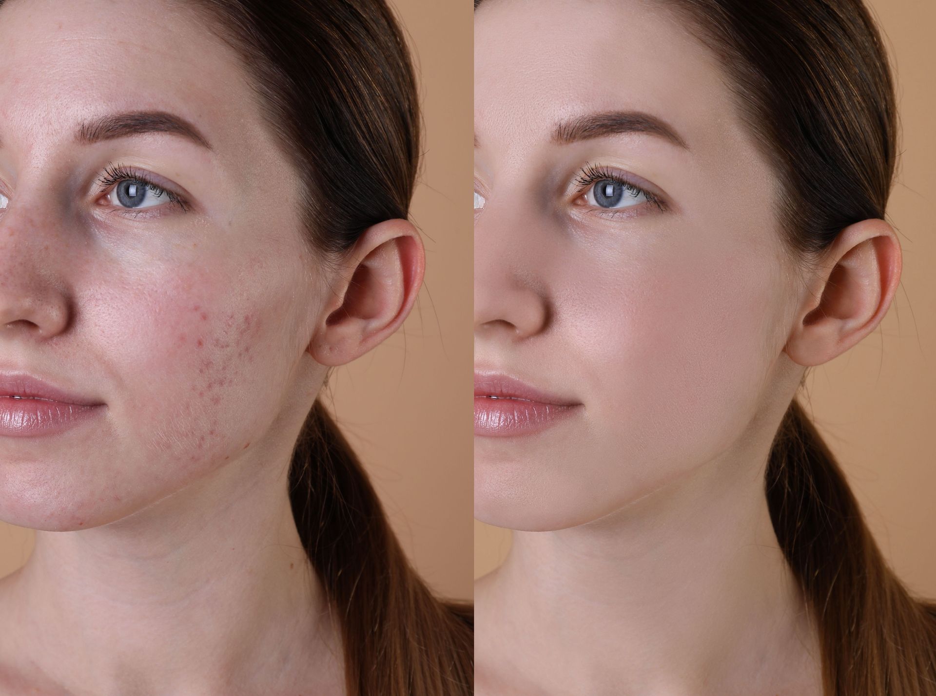 A split-screen comparison of a face showing improved skin texture and reduced blemishes on the right side.