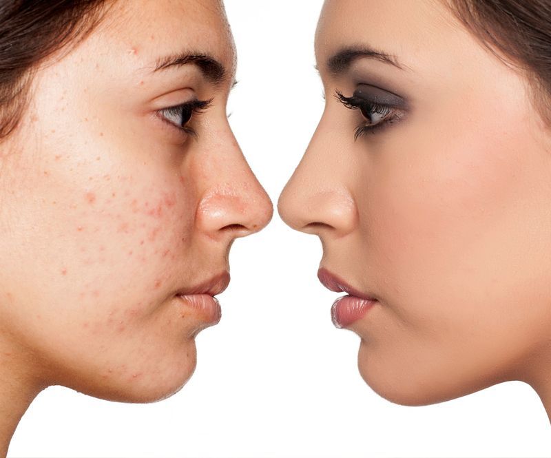 Two young women face each other in profile, one with acne and one with smooth makeup.