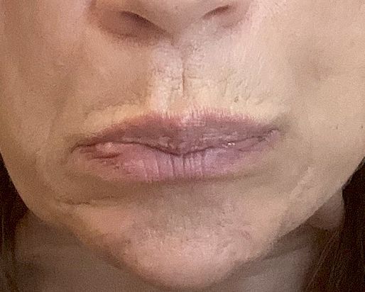 Close-up of a person's mouth and chin, showing dry, chapped lips and a small, raised bump on the lower lip.
