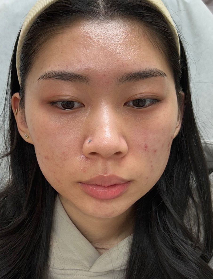 A front-facing close-up of a person with a neutral expression and some visible skin texture and minor blemishes.