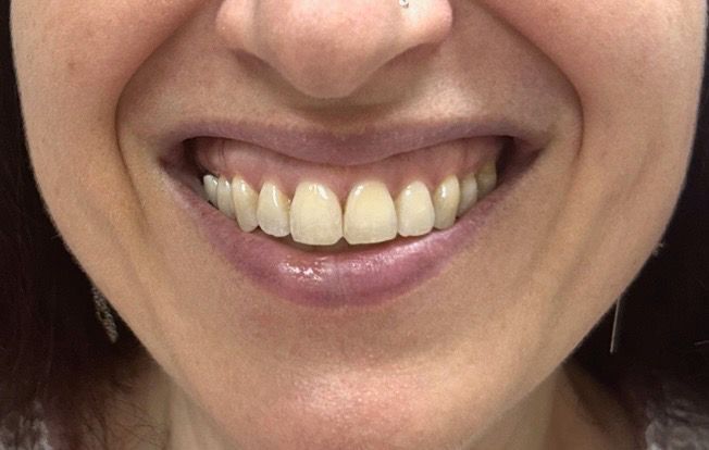 Close-up of a person smiling, showing their teeth and gums.