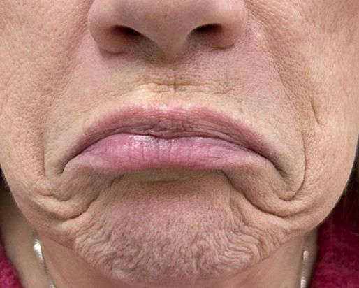 A close-up of a mouth with downturned lips, showing visible skin texture and creases around the chin and mouth area.