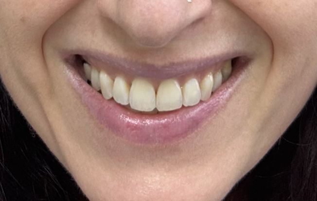 Close-up of a smiling mouth showing straight, healthy-looking teeth.