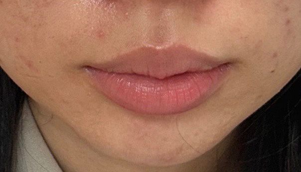Close-up view of a neutral, closed mouth and chin area with light skin and a faint dusting of small blemishes on the cheeks.