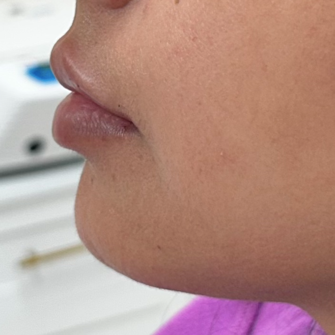 Side view of a person's face; shows the nose, lips, and jawline. Skin is smooth, and the person wears a pink shirt.