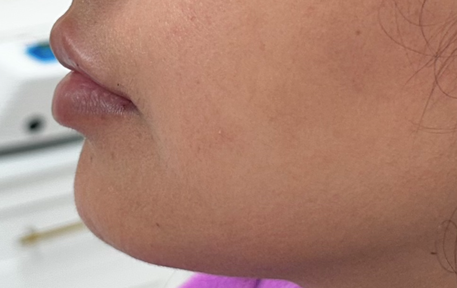 Side view of a person's face; shows the nose, lips, and jawline. Skin is smooth, and the person wears a pink shirt.