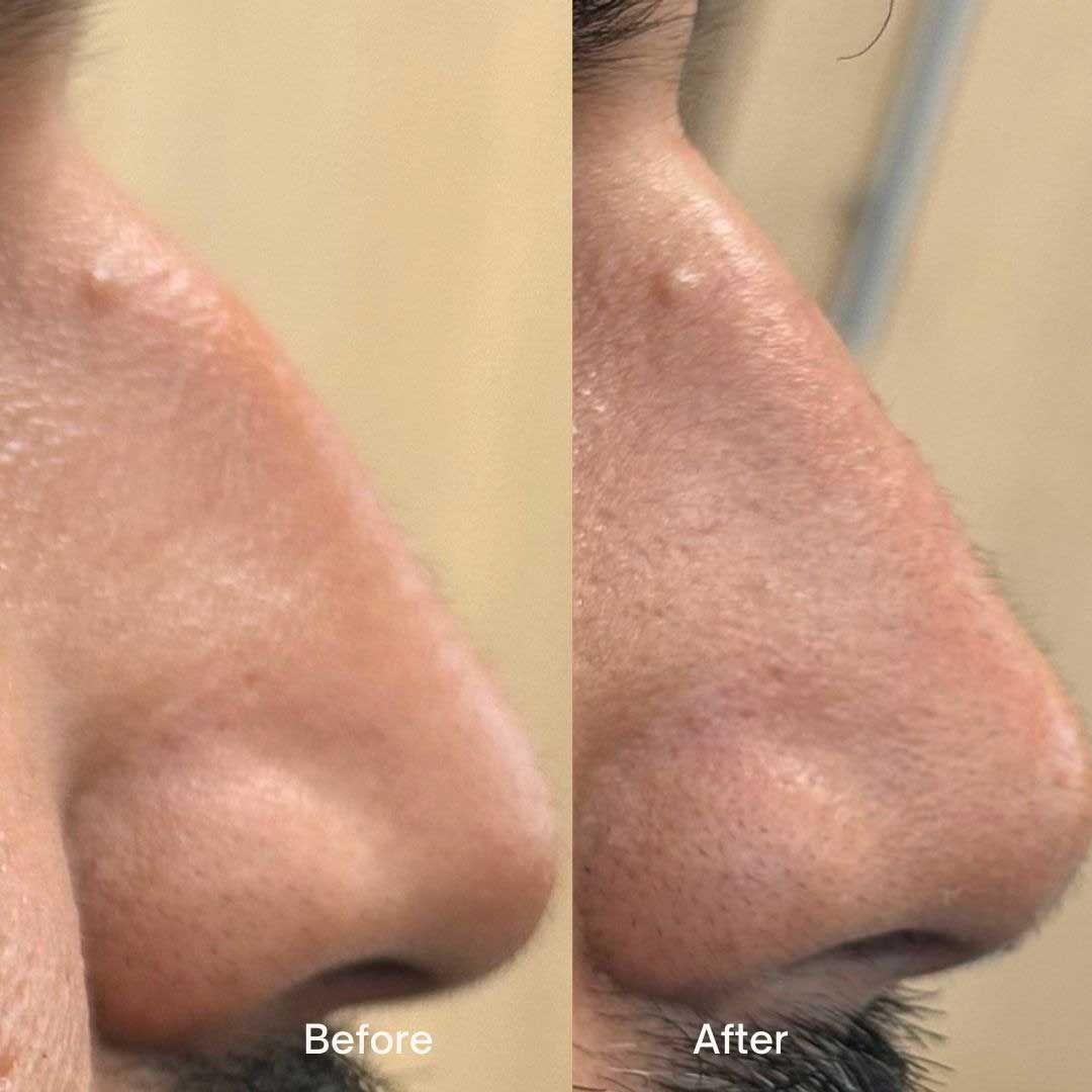 Side-by-side comparison: Before and after view of a person's nose, showing a change to the skin texture.
