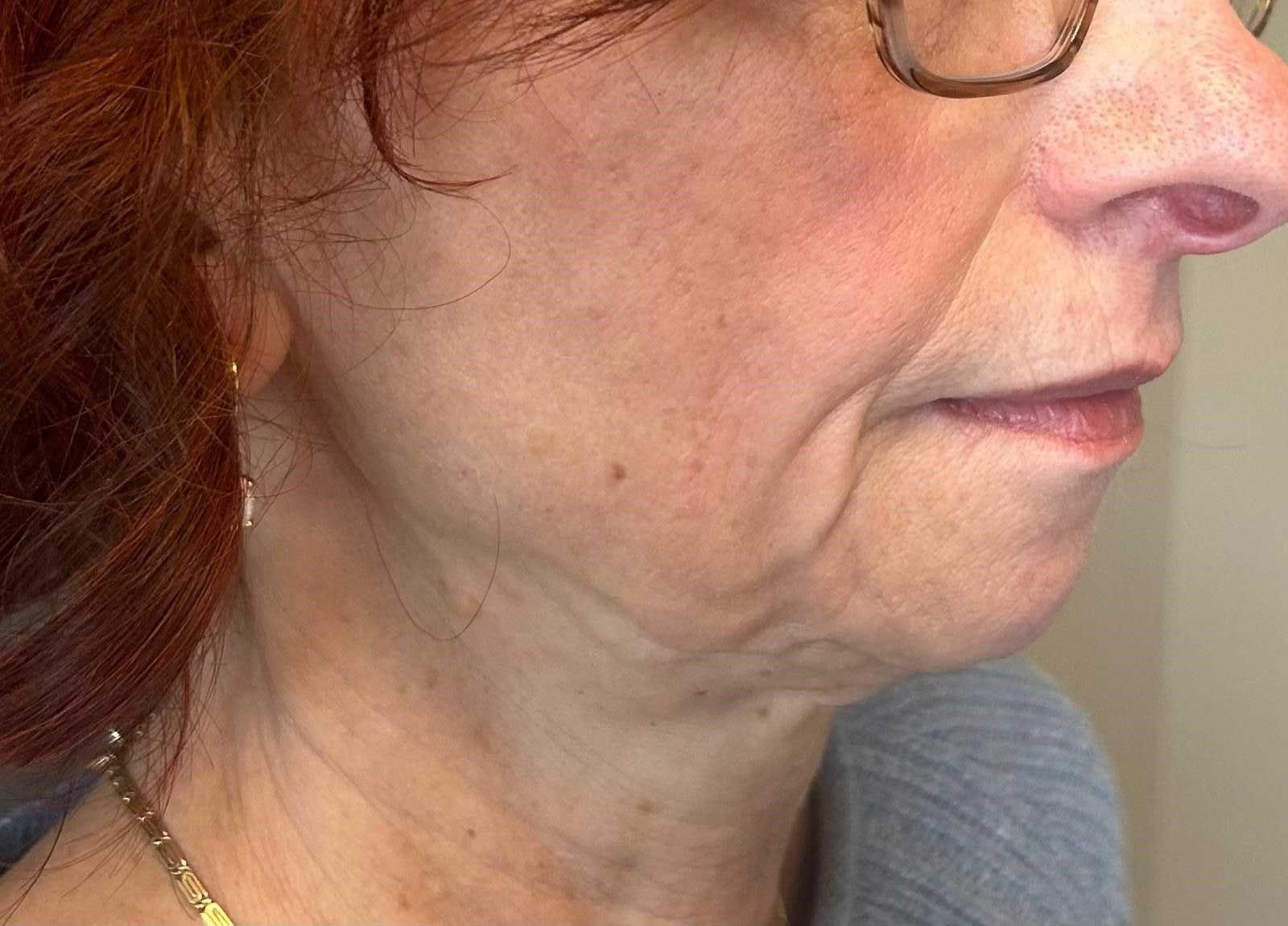 Woman's profile showing wrinkled skin on face and neck, wearing glasses and gray top.