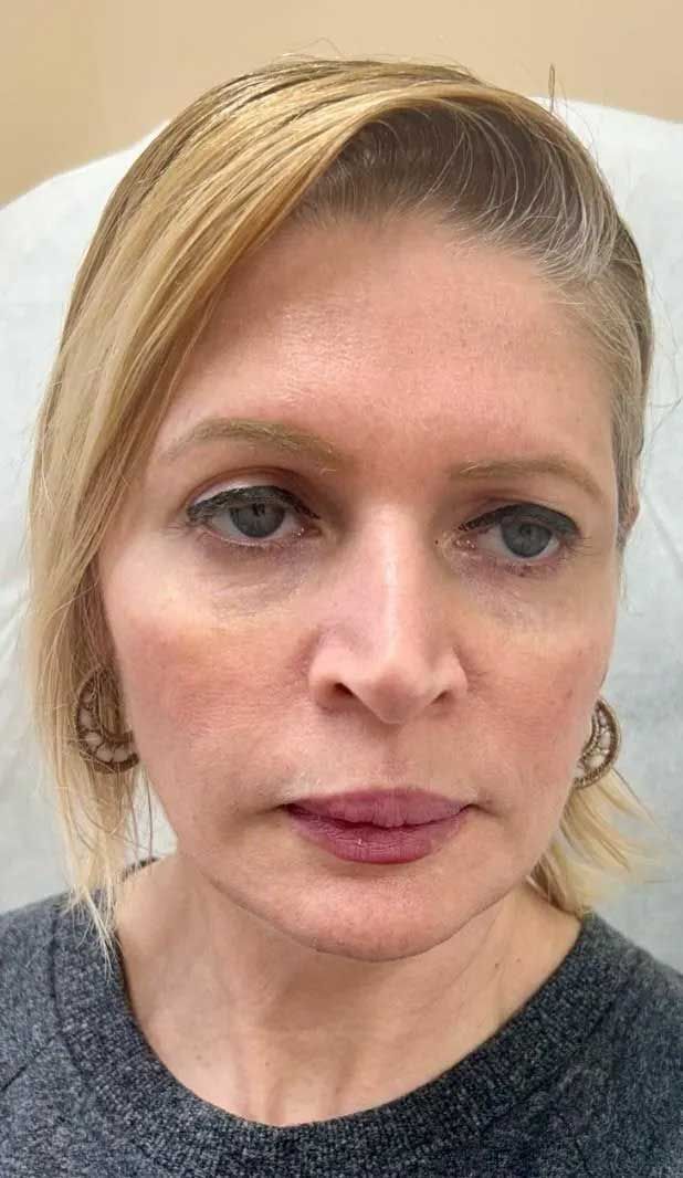 Woman with blonde hair, fair skin, and subtle makeup. In a medical setting, looking forward.