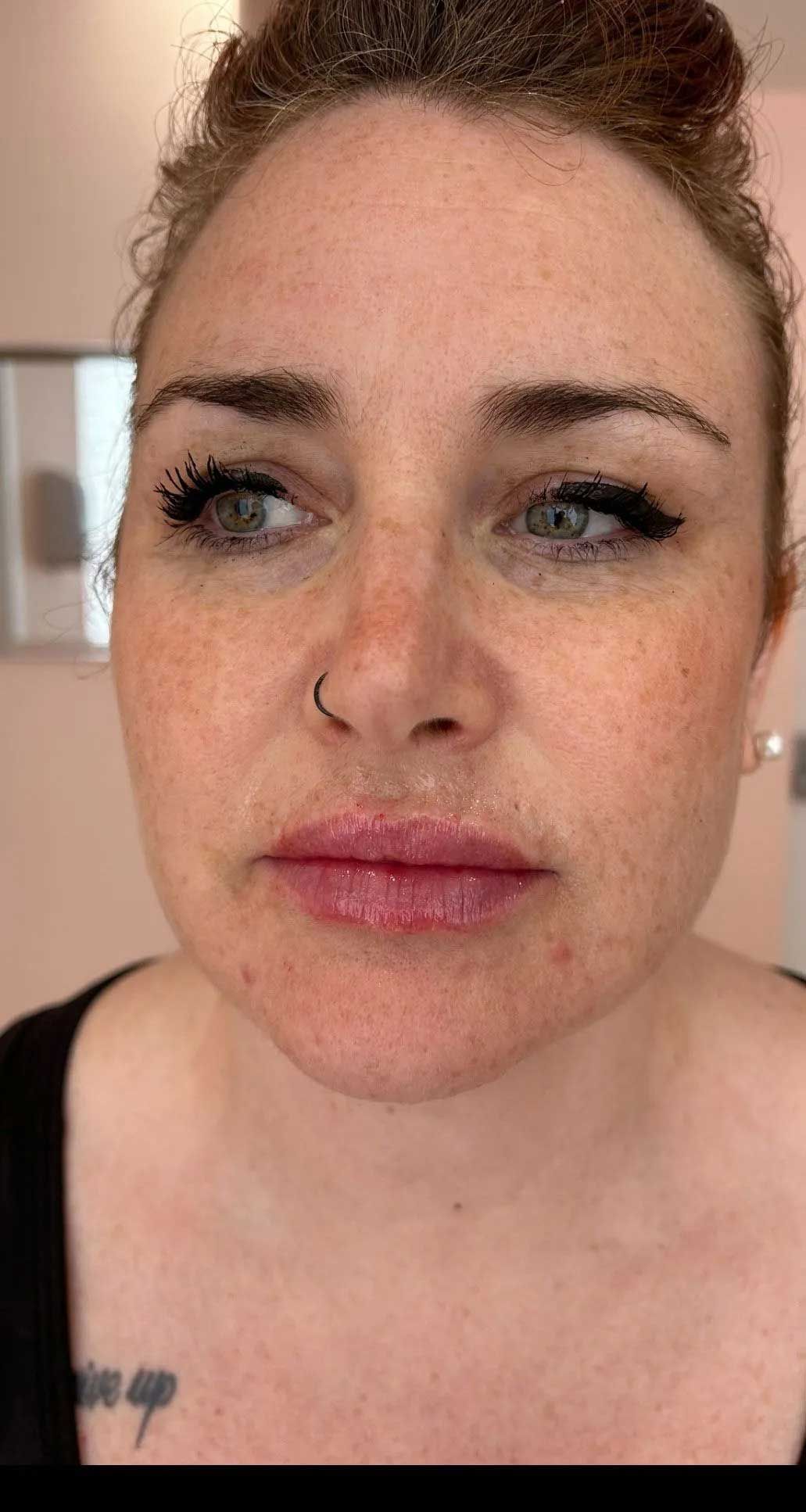 Woman with freckles, nose ring, and visible lip filler looking slightly to the side.