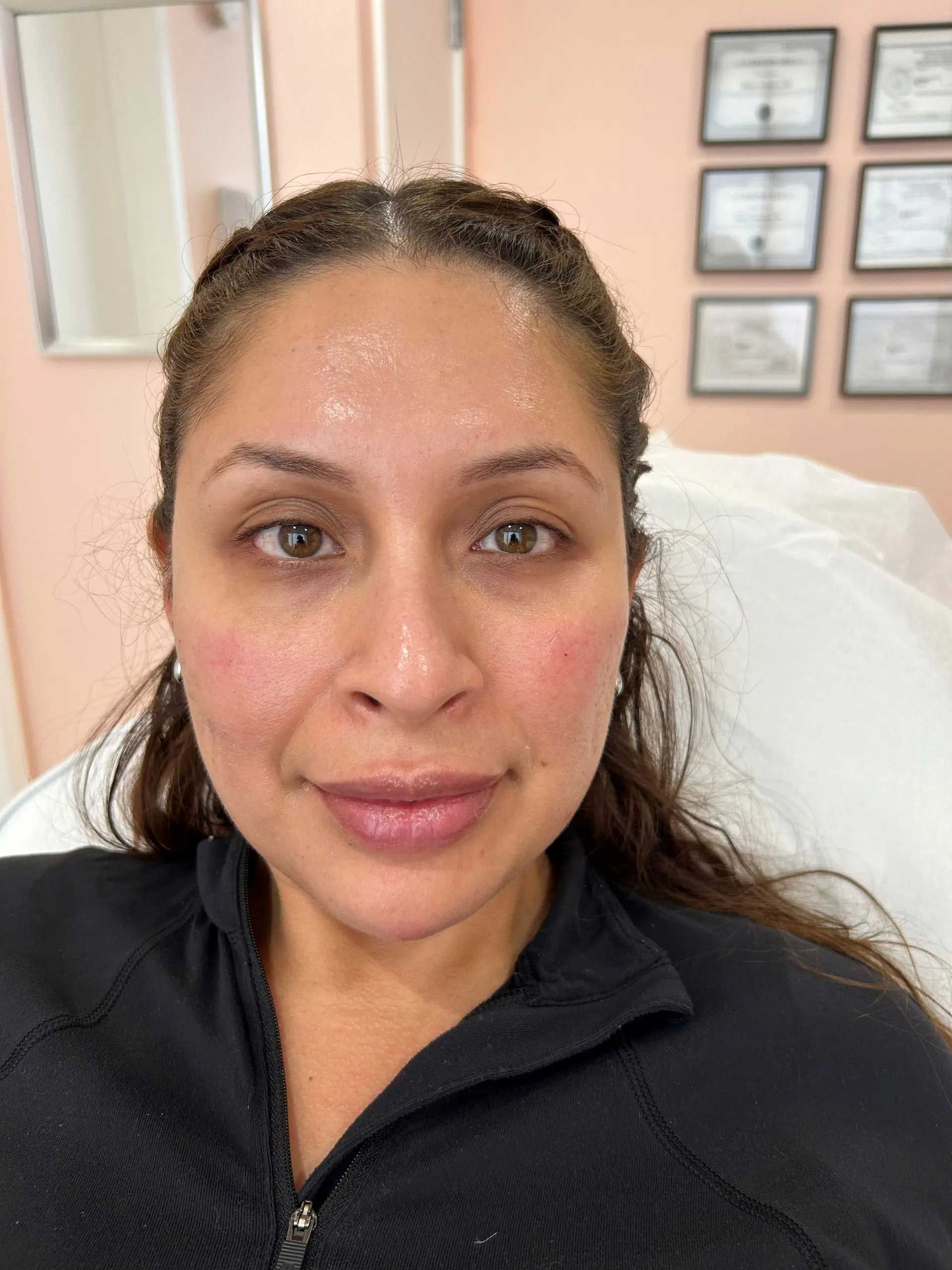 Woman with flushed skin post-procedure, in a treatment room.