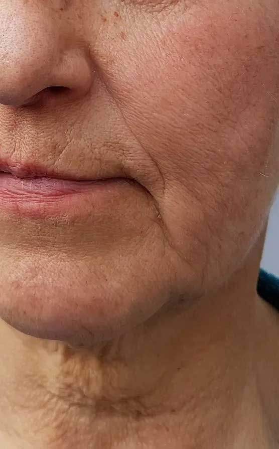 Close-up of an older person's face with wrinkles around the mouth and on the neck.