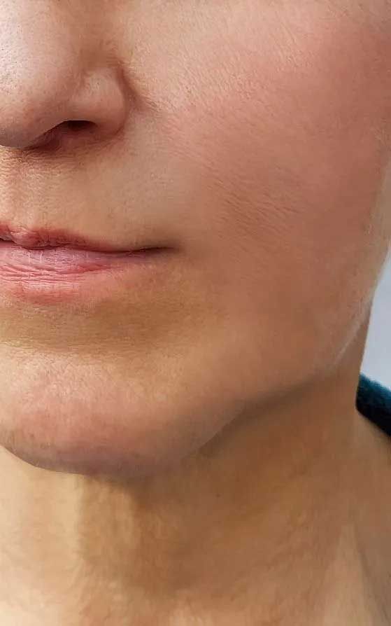 Close-up of a person's face, focusing on the nose, mouth, and chin. Neutral expression, fair skin.