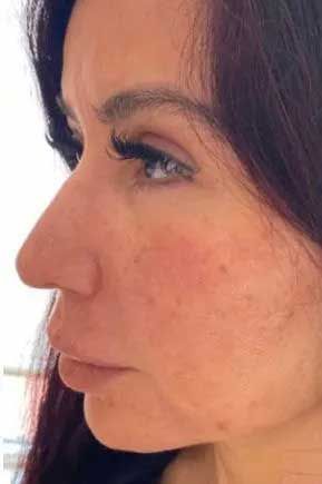 Woman's profile, looking left. She has long eyelashes and red spots on her face.