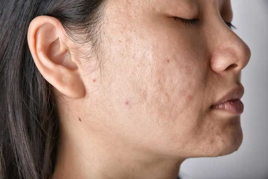Woman with closed eyes, side profile showing skin with acne scars.