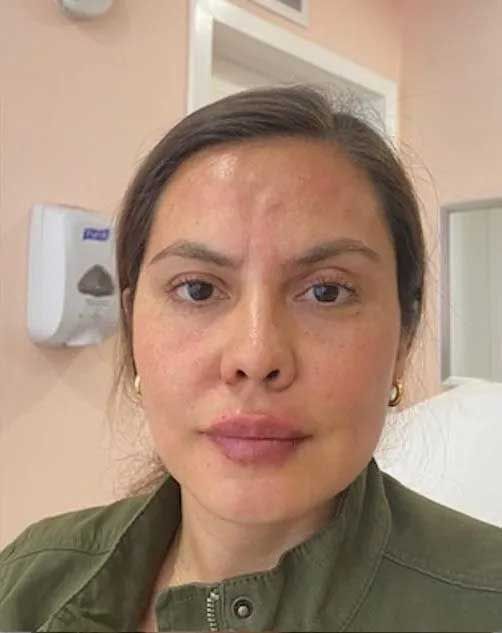 Woman with reddish skin on forehead and lips, wearing a green jacket. Inside a room.