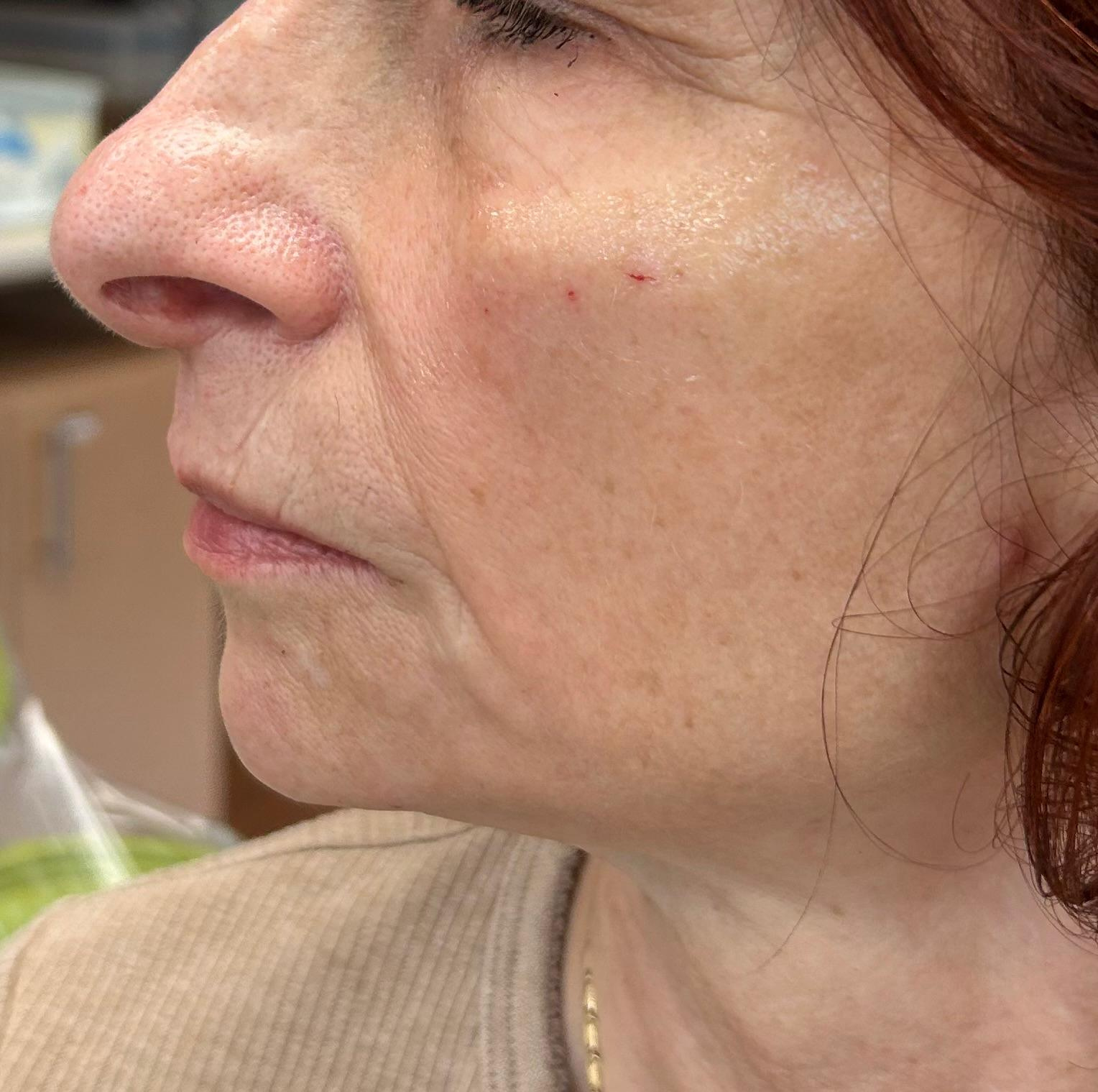 Woman's profile view, showing nose, lips, jawline, and neck with signs of aging. Skin is fair with visible pores and wrinkles.