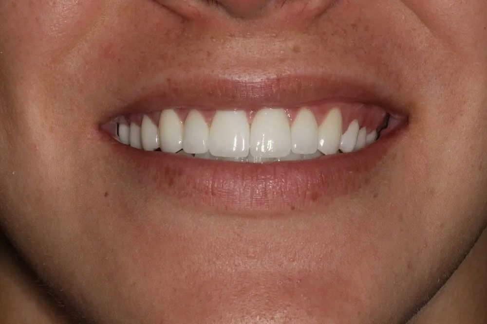 A close up of a woman 's smile with white teeth.