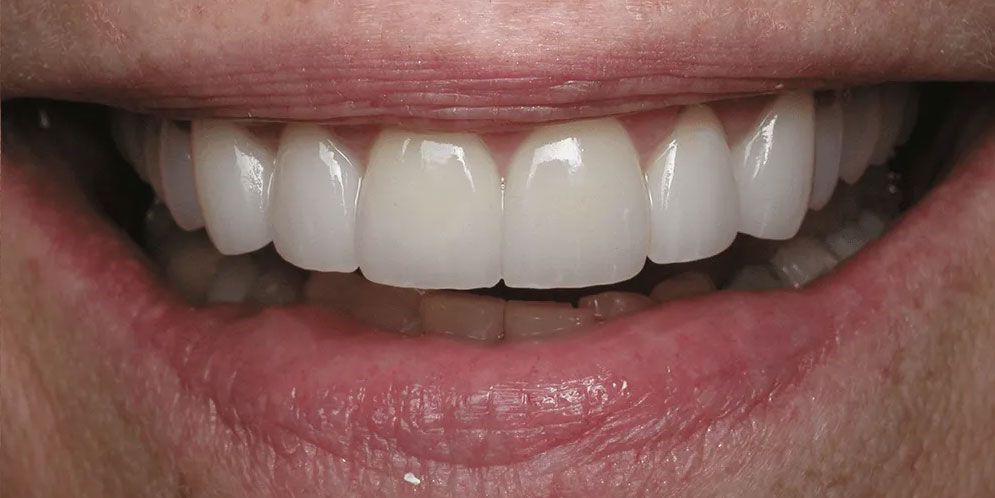 A close up of a person 's smile with white teeth.